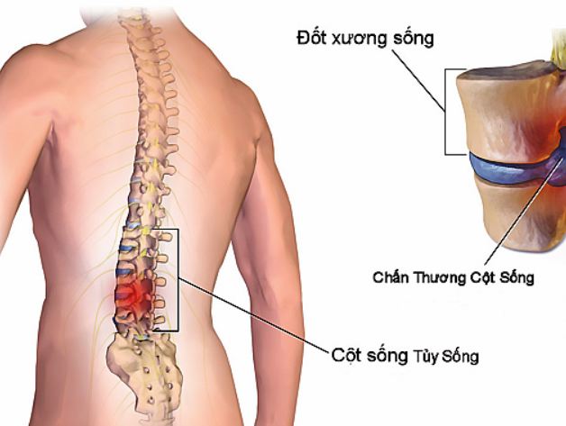 Acute Spinal Cord Injury - Hình ảnh minh họa